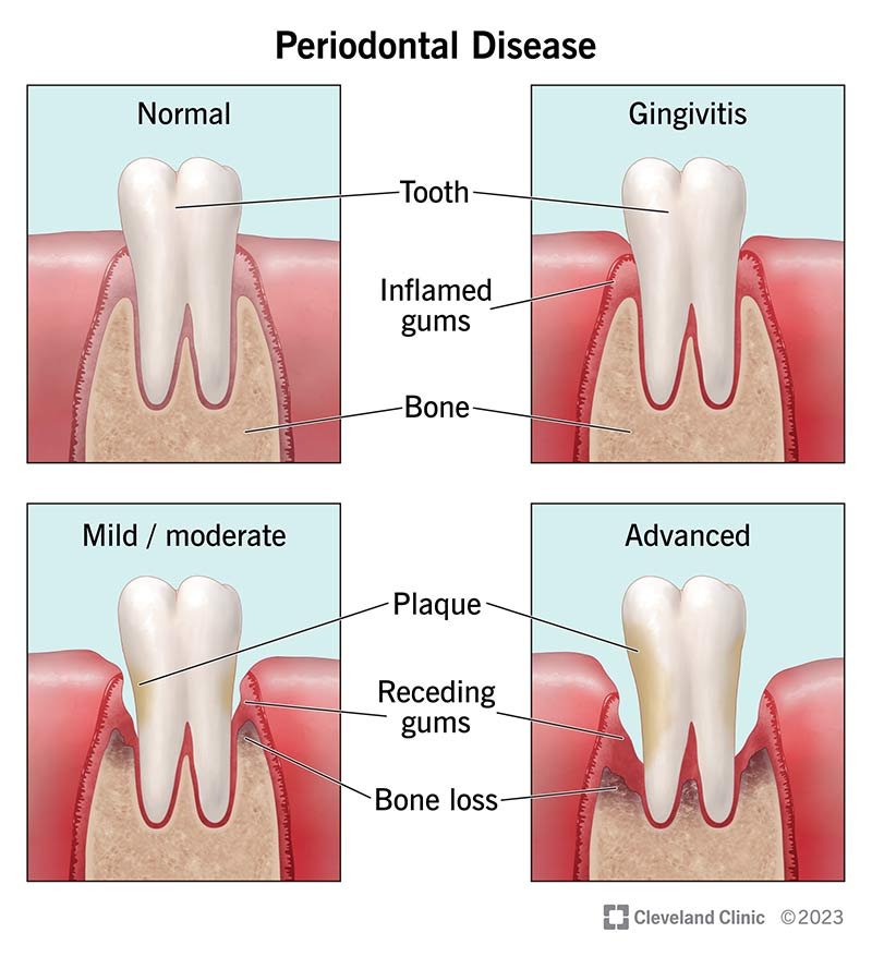 How Plaque Turns Into Tartar & Leads to Gum Disease — Explained by Dentesthetics, Greater Noida